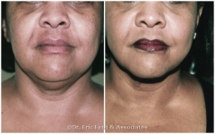 Face, Chin, and Neck Liposuction
