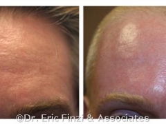 resurfacing fractional laser skin