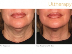 ultherapy-000p-044y_before-90daysafter_lower