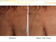 ultherapy_093-026-clb_beforeandafter-180day_1tx_chest