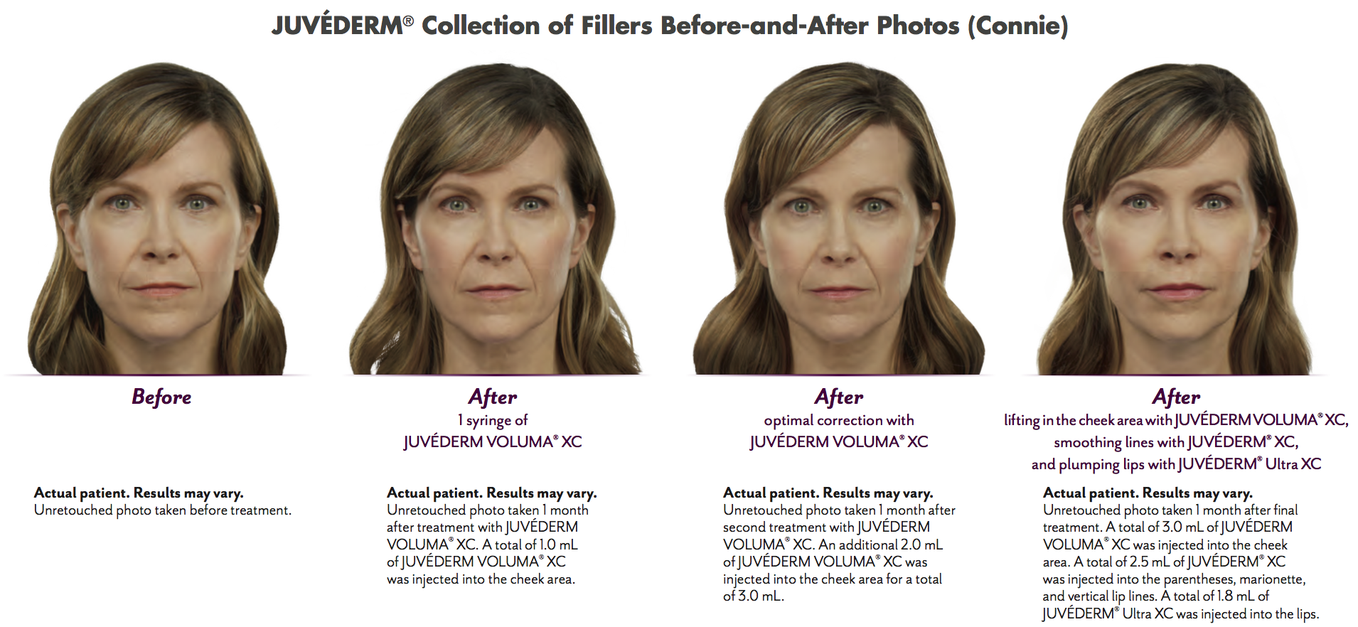 Juvederm Before and After Photos 