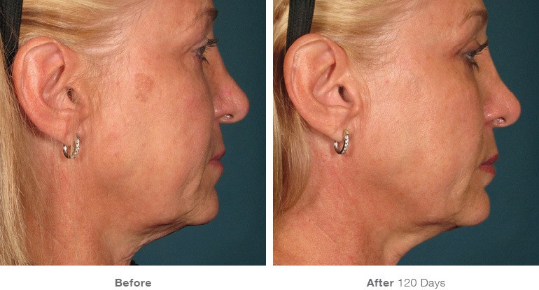 Ultherapy Before & After