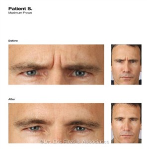 Male Botox Before & After at Chevy Chase Cosmetic Center