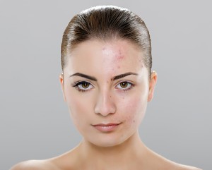 Acne Treatment by Dermatologist at Chevy Chase Cosmetic Center