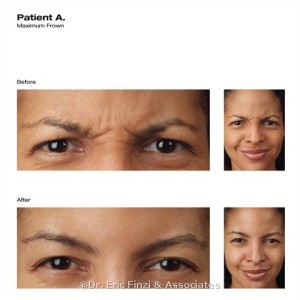 Female Botox Before & After Pictures