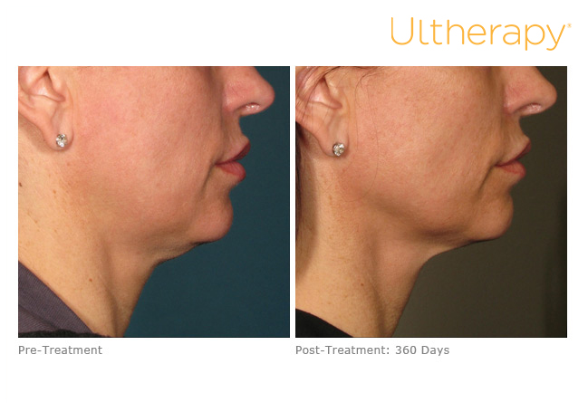 ultherapy-000p-015y_before-360daysafter_lower
