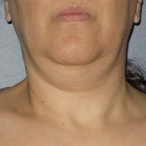 Ultherapy Skin Tightening Before & After