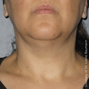 Ultherapy Skin Tightening Before & After 2