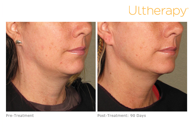 How Does Ultherapy Work