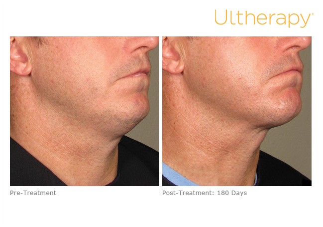 Ultherapy For Men