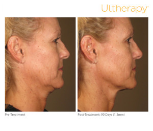 How much does Ultherapy cost
