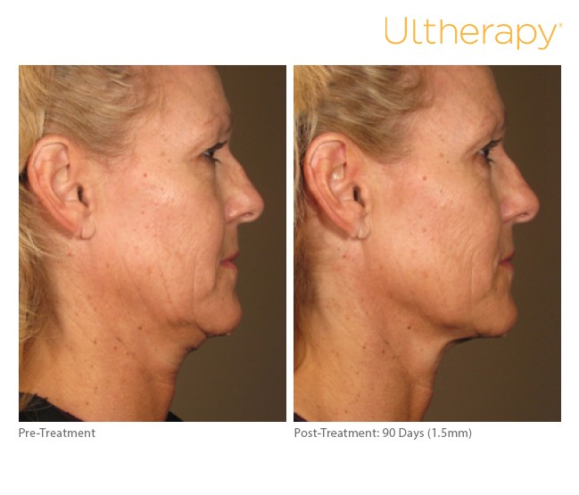 How much does Ultherapy cost