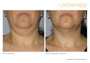 Ultherapy for Turkey Neck