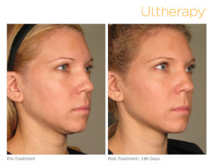 Ultherapy In Maryland