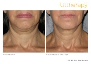 Before and After Ultherapy Pictures