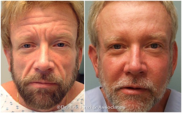 Male dermal filler botox 