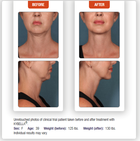 Kybella Chevy Chase Cosmetic Center