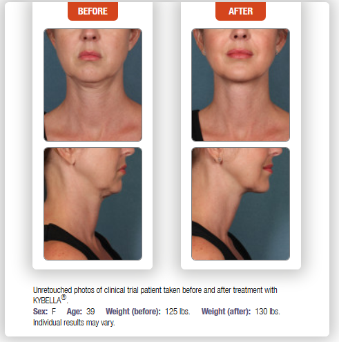 Kybella Chevy Chase Cosmetic Center 