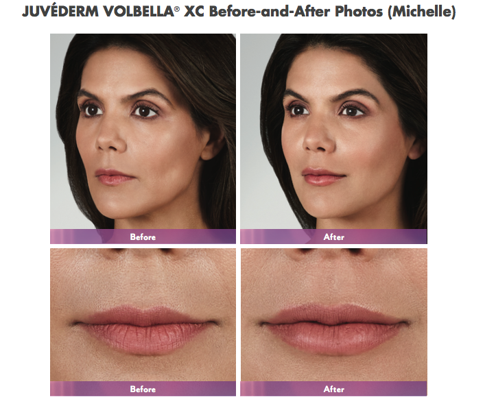 Juvederm Volbella Lip Injections Before and After Image