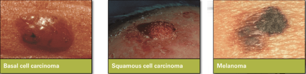 Types of Skin Cancer 