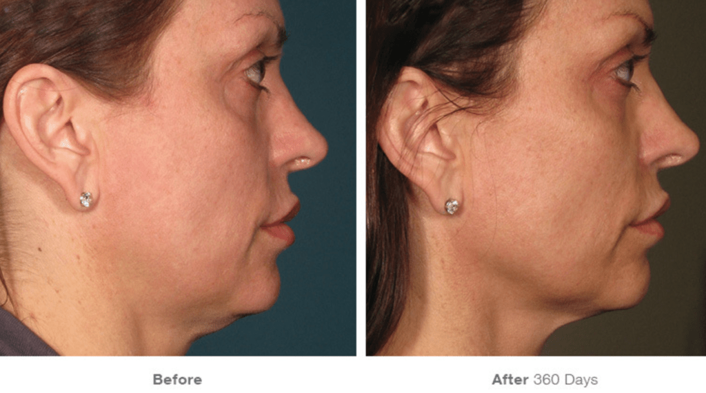 Ultherapy Before and After Treatment pictures 