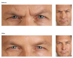 Male Botox Before and After Image