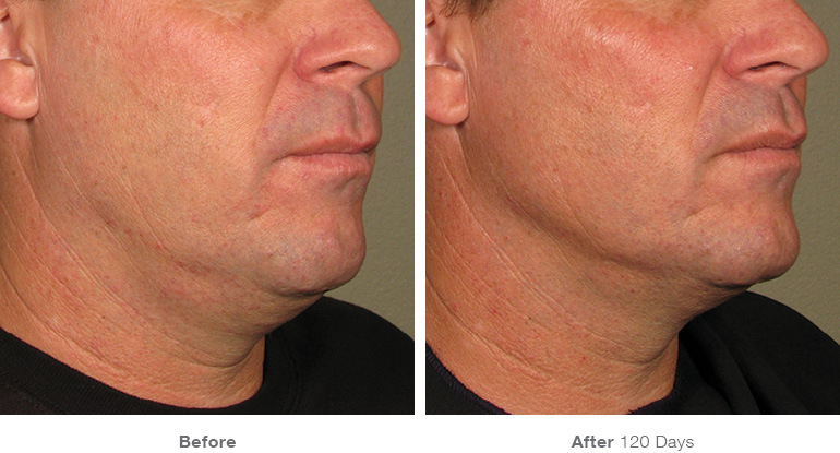 man ultherapy before and after image