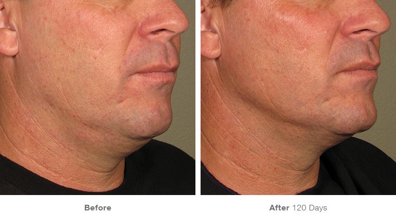 man ultherapy before and after image