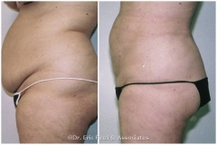 Abdominal Liposuction