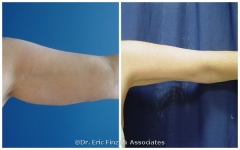 Arm Liposuction