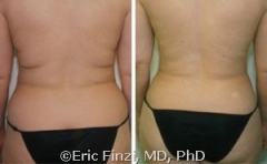 Back Liposuction