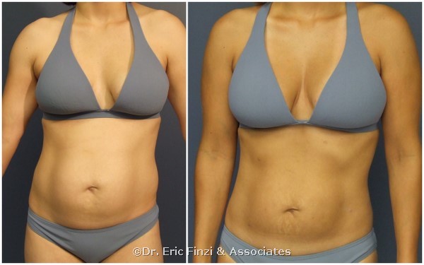 Fat Grafting To Breasts Before And After