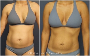 Fat Transfer, Liposuction, Chevy Chase Cosmetic Center