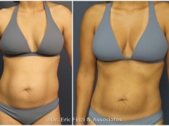 Fat Transfer, Liposuction, Chevy Chase Cosmetic Center