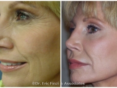 POST JUVEDERM BOTOX 1ST TREATMENT