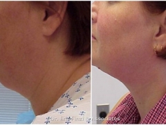 Liposuction - Neck2