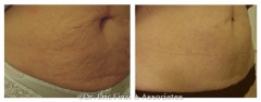 Fractional Skin Resurfacing Laser