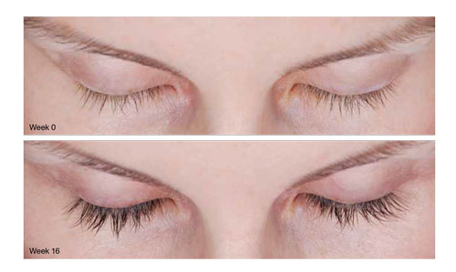 latisse lashes effects side eyelashes lattise possible longer peoria clinical patient ba