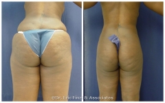 Thigh Liposuction