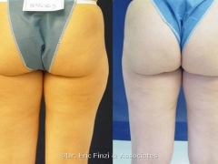 Liposuction - Outer Thighs