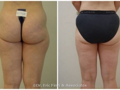 Liposuction - Outer Thighs2