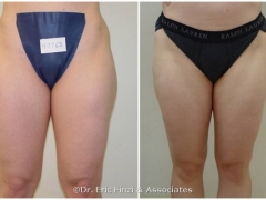Liposuction - Outer Thighs3