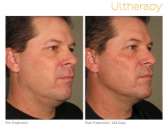 ultherapy-0058d_before-120daysafter_full