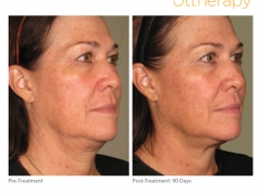 ultherapy-0236l-r_before-90daysafter_full
