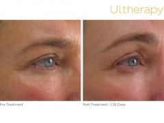 ultherapy-024g-002u_before-120daysafter_brow