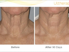 ultherapy-bl0017_beforeandafter_90day_1tx_neck