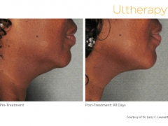 ultherapy-ll01_before-90daysafter_lower
