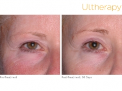 ultherapy-mrn22_before-90daysafter_brow