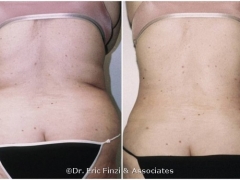 Lipo Flanks - Waist