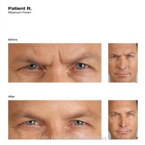 Male Botox Before & After at Chevy Chase Cosmetic Center